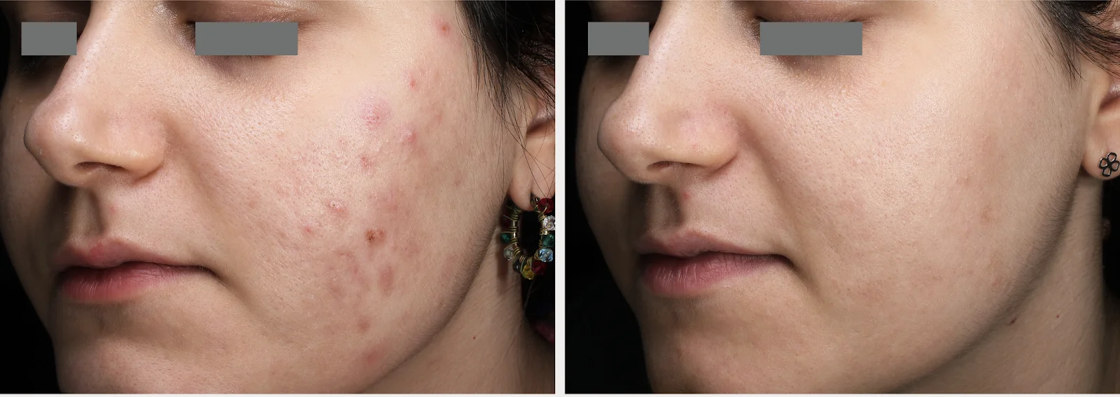 ACNE-Ain Bellaire, TX