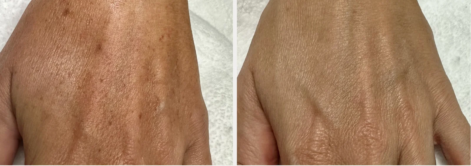 HYPERPIGMENTATION_ MELASMA-Ain Bellaire, TX