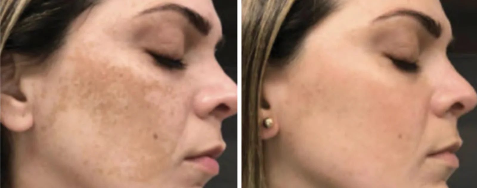 HYPERPIGMENTATION_ MELASMA-Bin Bellaire, TX
