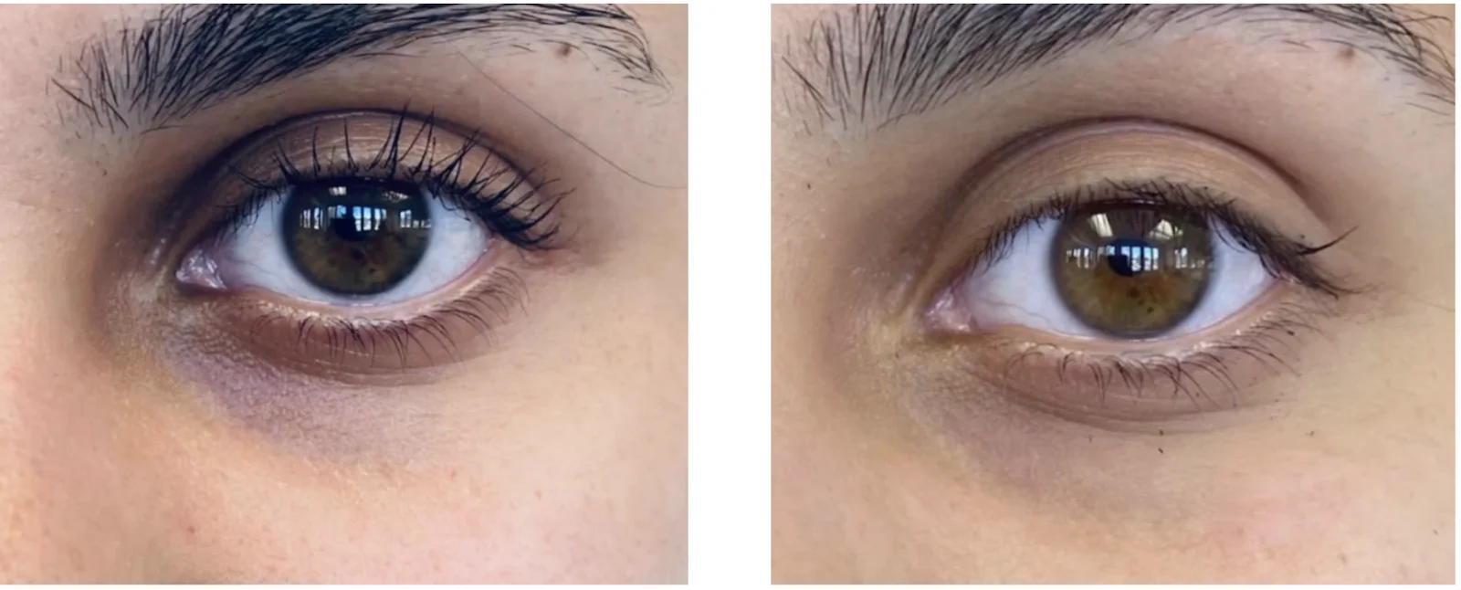 HYPERPIGMENTATION_ MELASMA-Cin Bellaire, TX