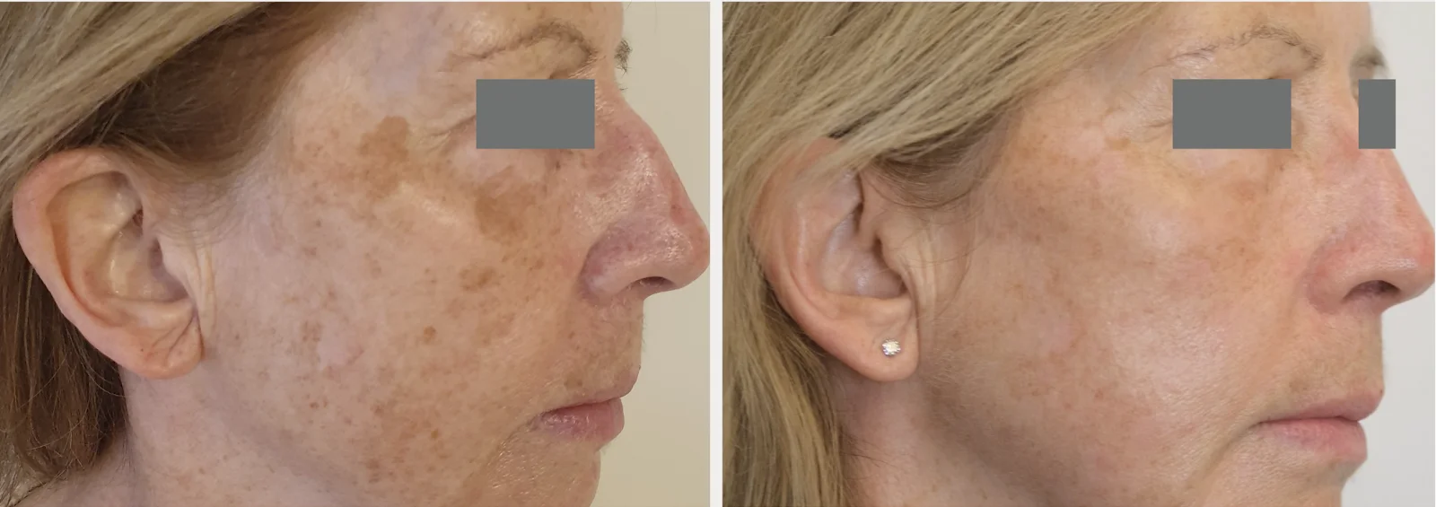 HYPERPIGMENTATION_ MELASMAin Bellaire, TX