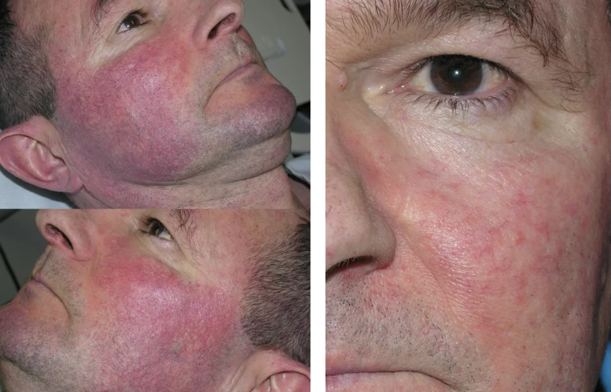ROSACEA_ TELANGICTASIAS-Ain Bellaire, TX