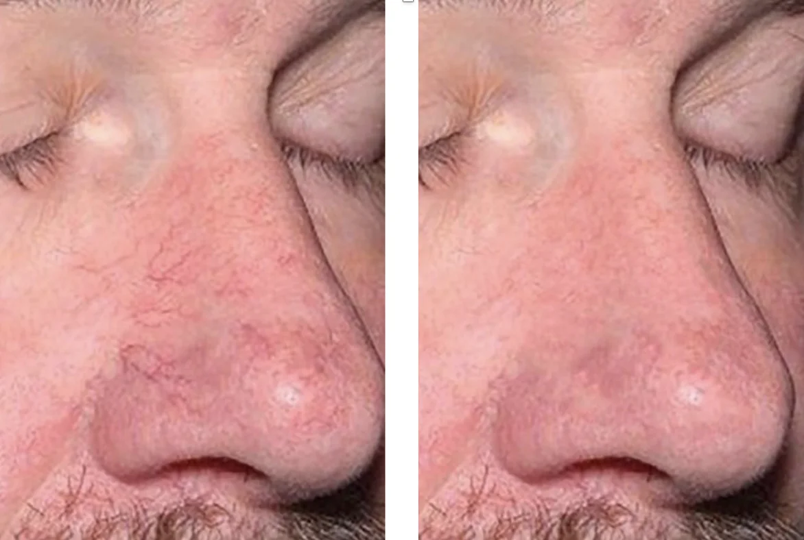 ROSACEA_ TELANGICTASIAS-Bin Bellaire, TX