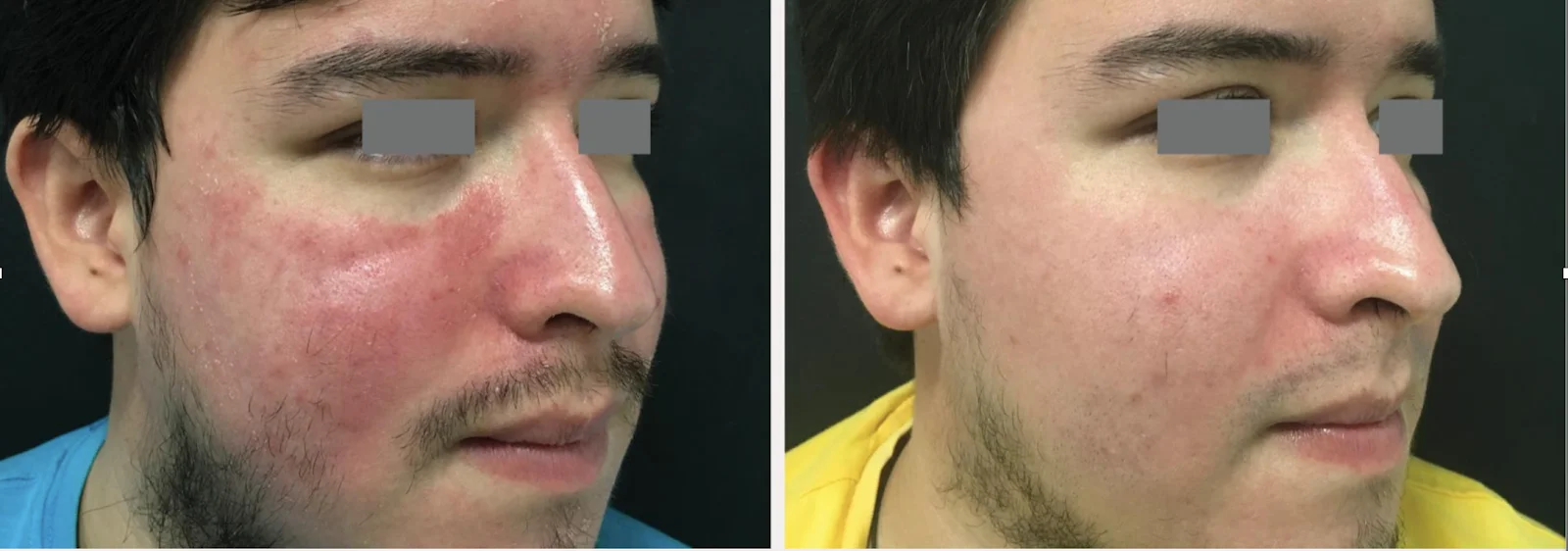 ROSACEA_ TELANGICTASIASin Bellaire, TX