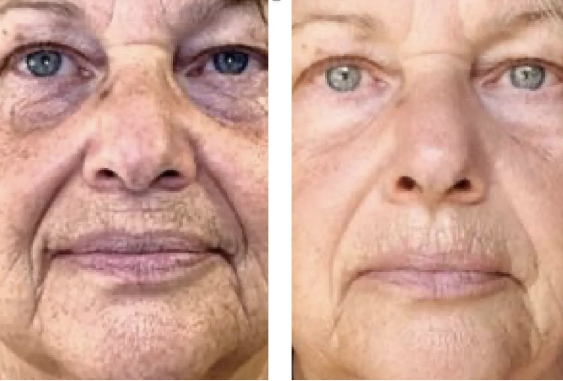 SKIN REJUVENATION-Ain Bellaire, TX