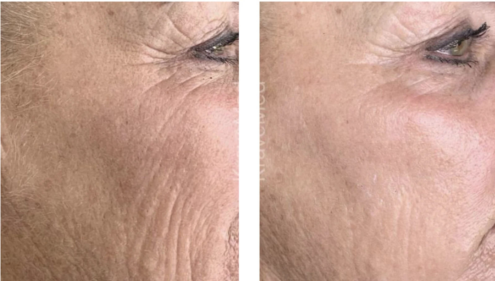 SKIN REJUVENATIONin Bellaire, TX