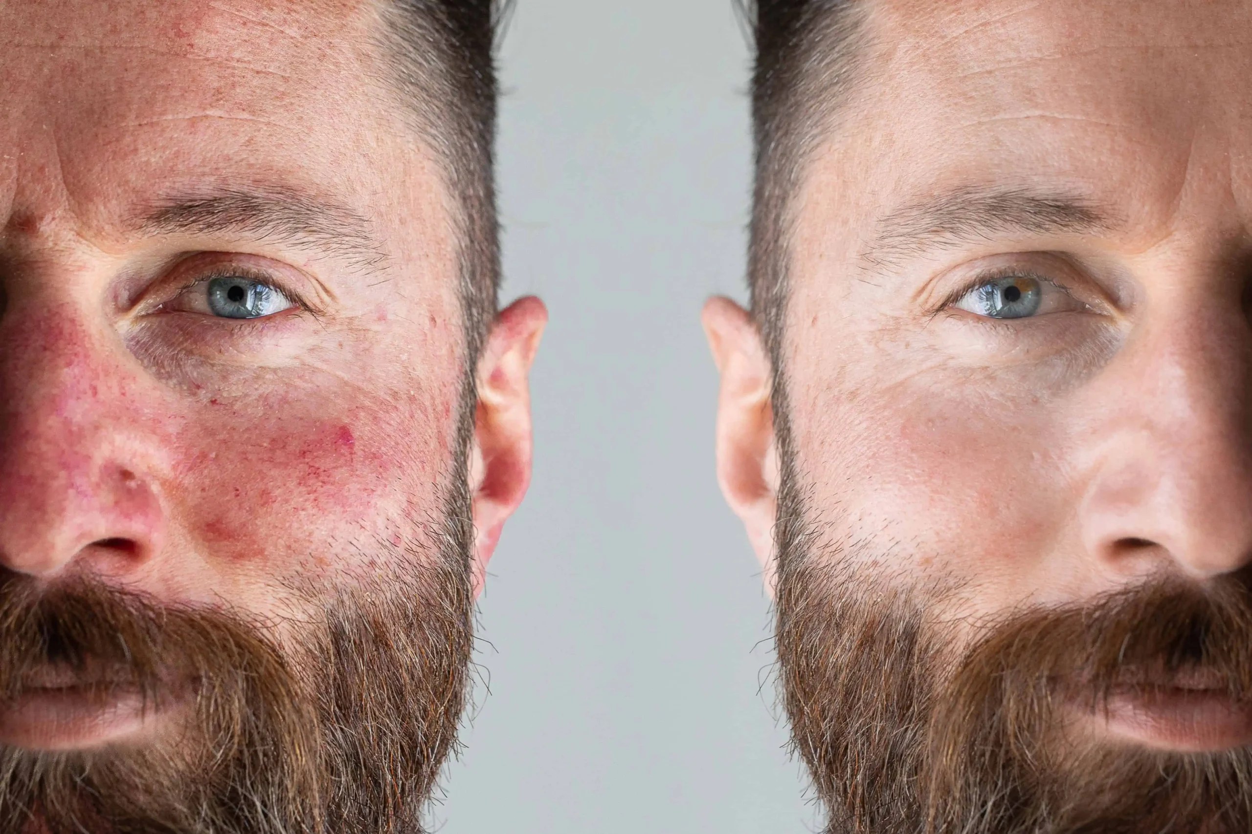 Acne-before-and-after-3