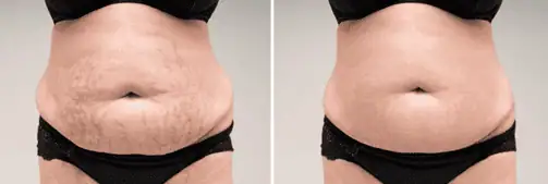 Striae