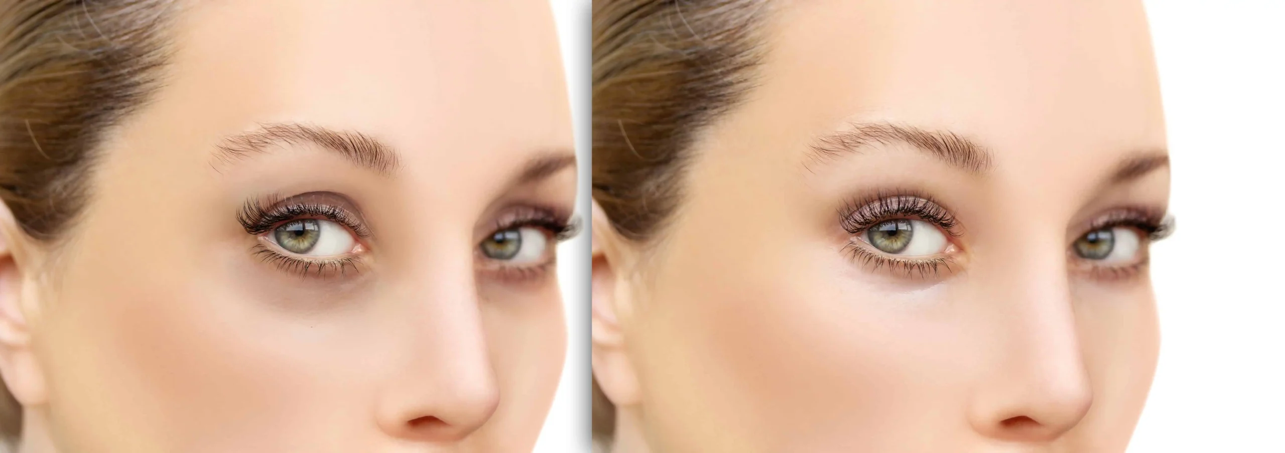 dermal fillers before and after 1