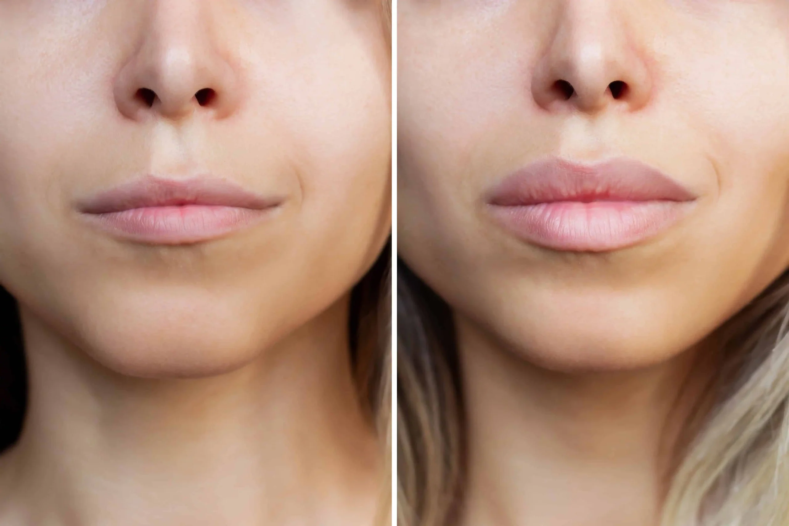 dermal fillers before and after 2