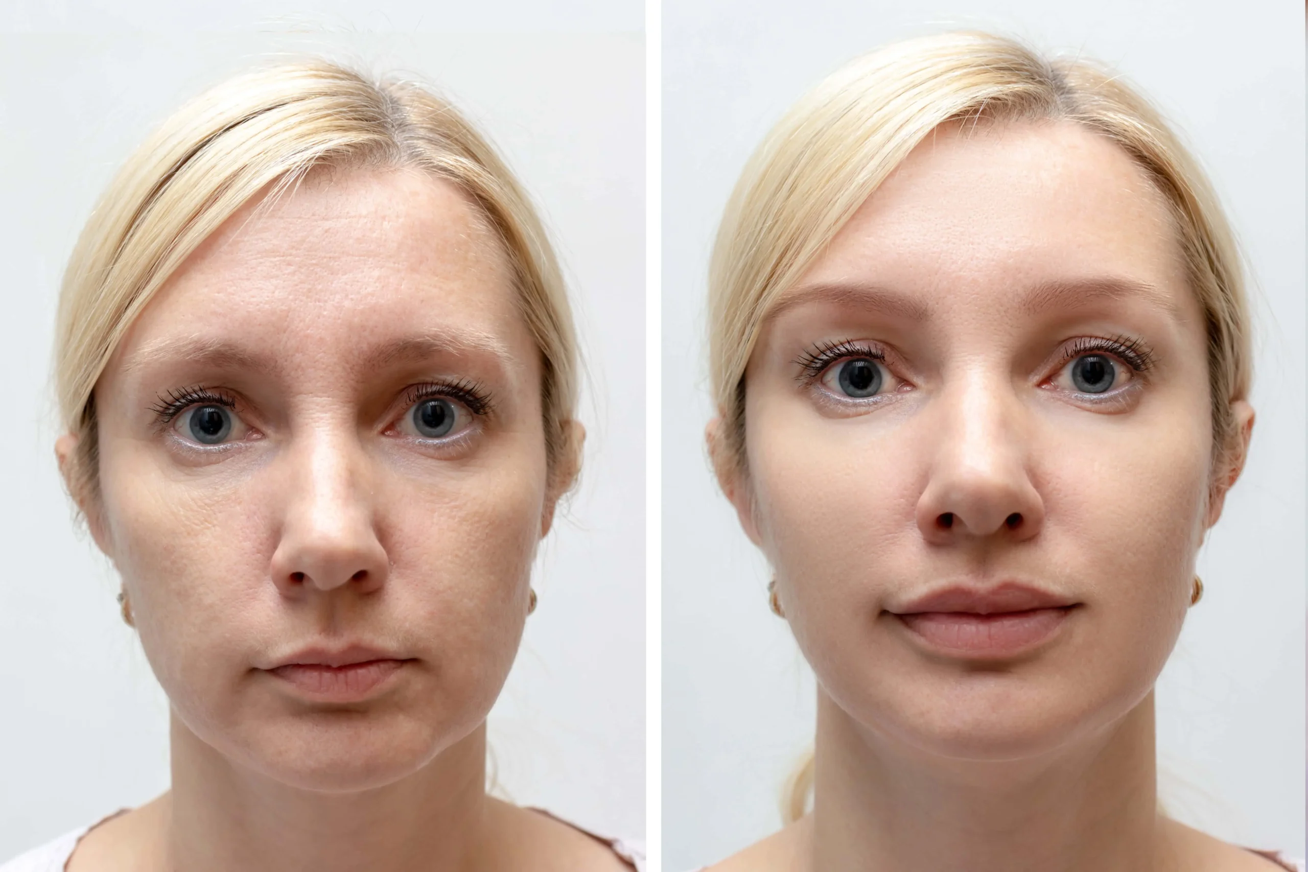 dermal fillers before and after 3