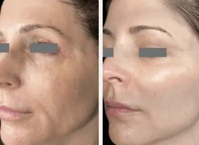 microneedling-1