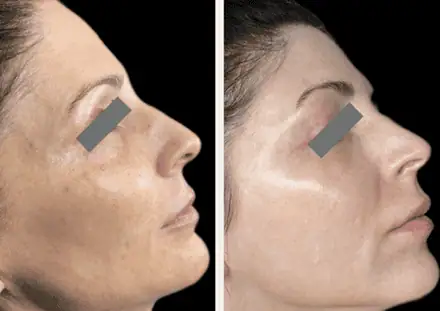 microneedling 2