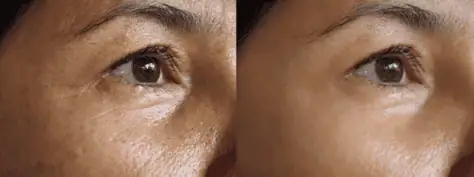 skin rejuvenation before and after
