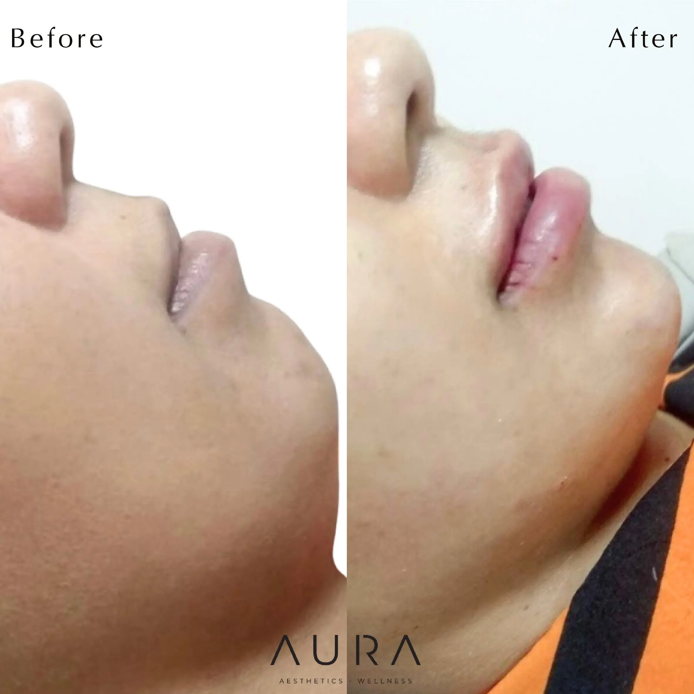 Dermal Filler - Chin and Lip
