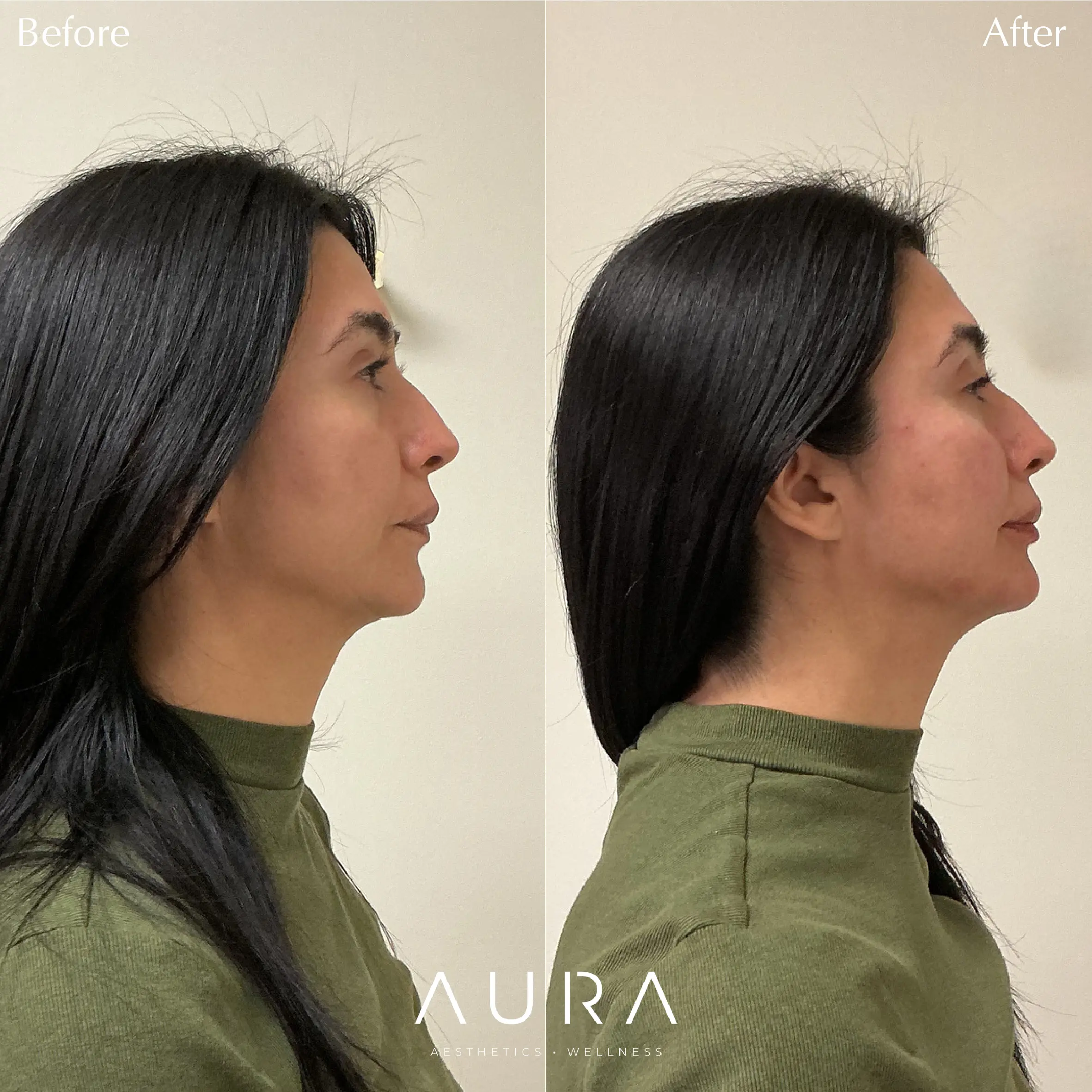 Dermal Filler - Chin