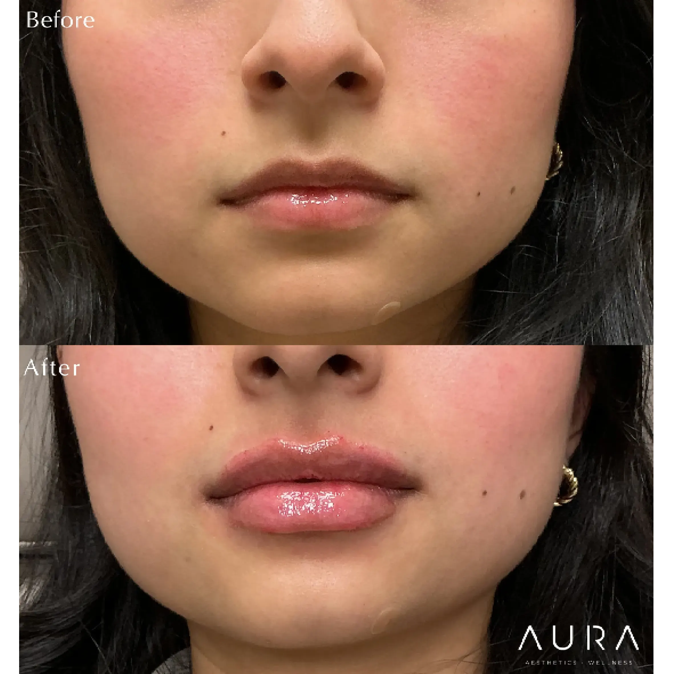 Dermal Fillers - Lips