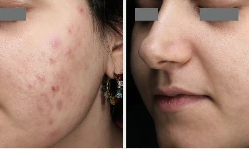 ACNE-Ain Bellaire, TX