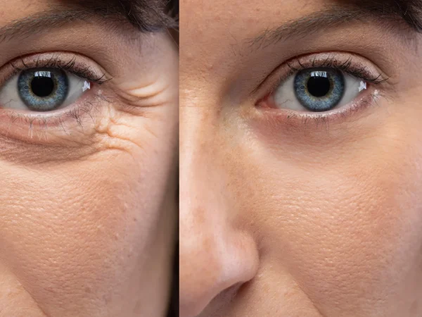 Botox-A-in Bellaire, TX