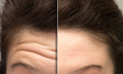Botox-in Bellaire, TX