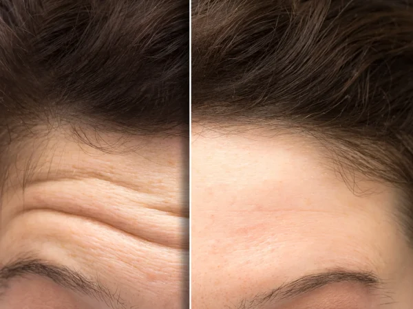 Botox-in Bellaire, TX