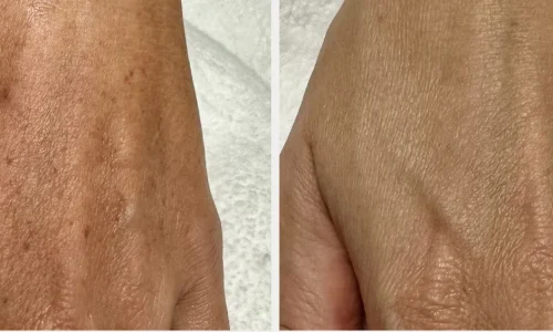 HYPERPIGMENTATION_ MELASMA-Ain Bellaire, TX