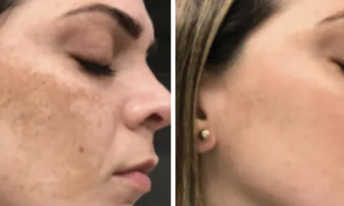 HYPERPIGMENTATION_ MELASMA-Bin Bellaire, TX