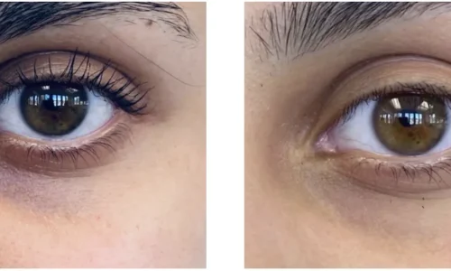 HYPERPIGMENTATION_ MELASMA-Cin Bellaire, TX