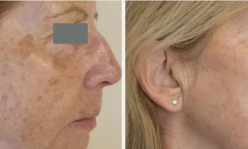 HYPERPIGMENTATION_ MELASMAin Bellaire, TX