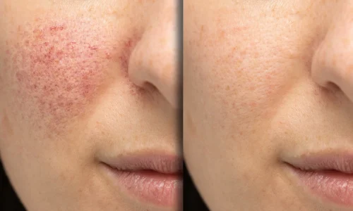 LASERS BEFORE AFTER-in Bellaire, TX