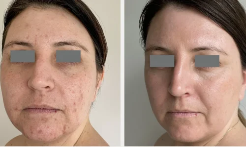MICRONEEDLING SKIN BEFORE AFTERin Bellaire, TX