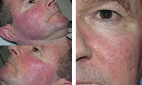 ROSACEA_ TELANGICTASIAS-Ain Bellaire, TX