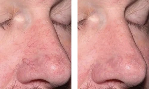 ROSACEA_ TELANGICTASIAS-Bin Bellaire, TX