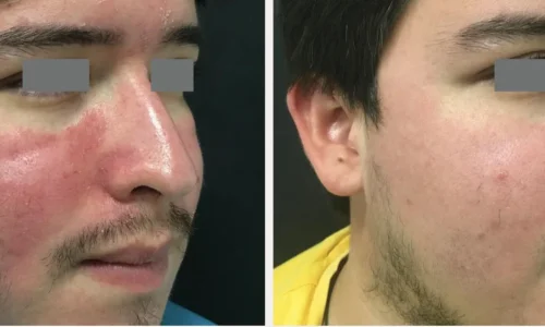 ROSACEA_ TELANGICTASIASin Bellaire, TX