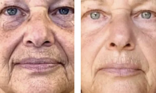 SKIN REJUVENATION-Ain Bellaire, TX