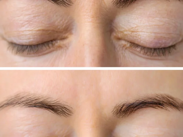 botox before and after